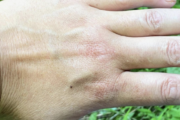 Close-up of a hand with a dark watch on the wrist. The hand is positioned palm down, showing the skin and veins, against a green outdoor background.